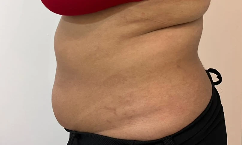 Contorno abdominal antes do protocolo, em vista lateral