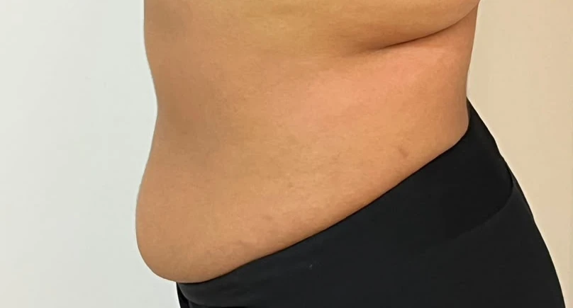 Contorno abdominal depois do protocolo, em vista lateral