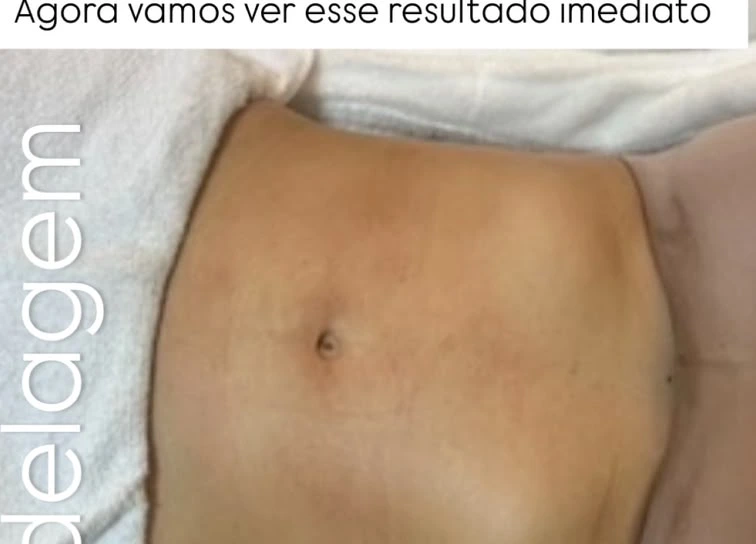 Abdômen trabalhado em protocolo de lipomodelagem